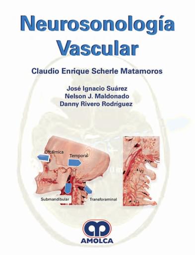 Neurosonología vascular