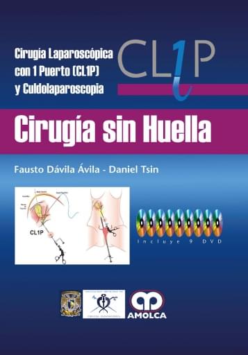 Cirugía sin Huella Cirugía Laparoscópica con 1 Puerto (CL1P) y Culdolaparoscopia