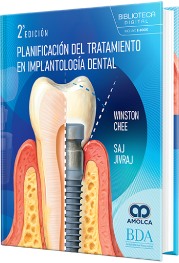 Planificación del tratamiento en implantología dental