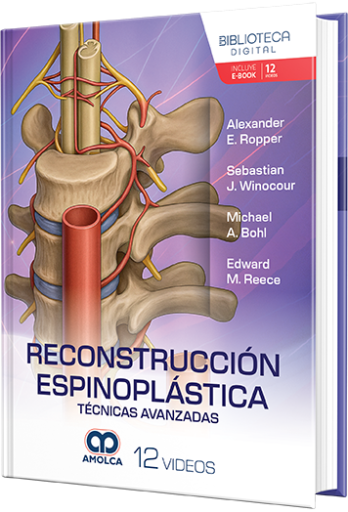 Reconstrucción espinoplástica. Técnicas avanzadas