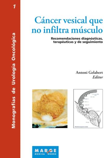 Cáncer vesical que no infiltra músculo