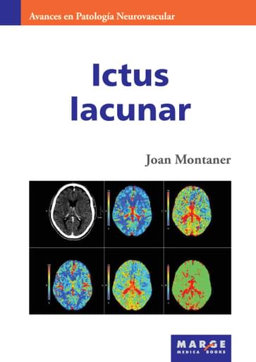 Ictus lacunar