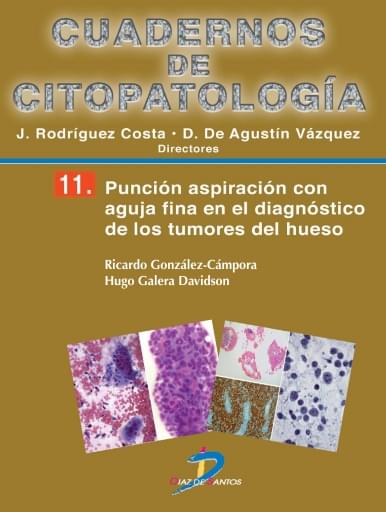Punción aspiración con aguja fina en el diagnostico de los tumores de hueso