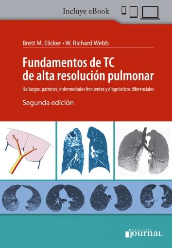 Fundamentos de TC de alta resolución pulmonar