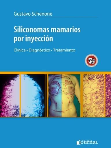 Siliconomas Mamarios por Inyección
