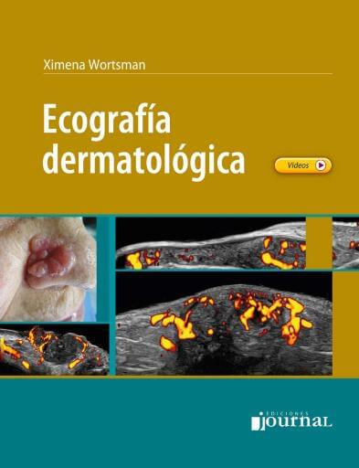 Ecografía dermatológica