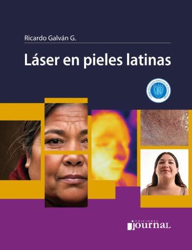 Láser en pieles latinas