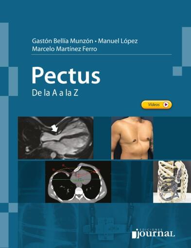 Pectus de la A a la Z