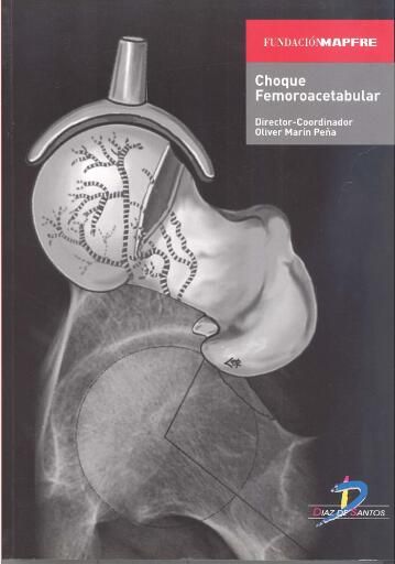 Choque Femoroacetabular