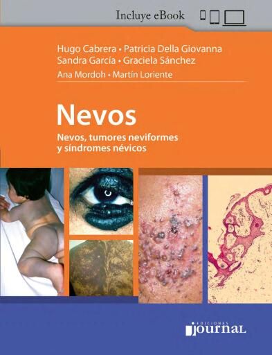 Portada del libro «Nevos, tumores neviformes y síndromes névicos», de Hugo Cabrera, Patricia Della Giovanna