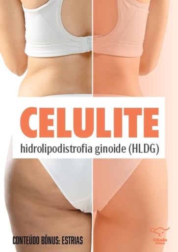 Celulite (hidrolipodistrofia ginoide - HLDG) e Estrias