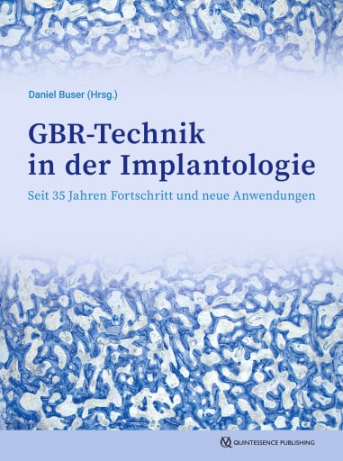 GBR-Technik in der Implantologie